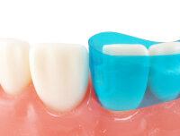 VariStrip Frontzahnmatrizenbänder